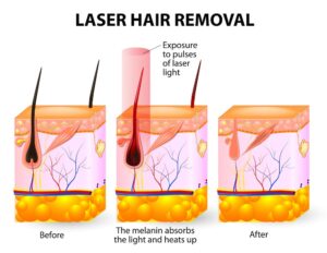 Do you Need Laser Hair Removal in Palm Springs CA? - TRANSGENDER HEALTH &  WELLNESS CENTER
